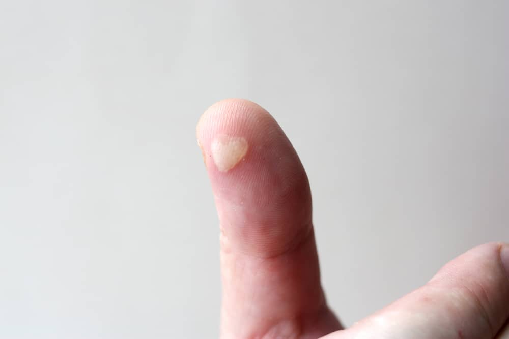 A heart-shaped thermal burn on a man's thumb