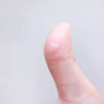 Blisters with fluid inside on thumb finger