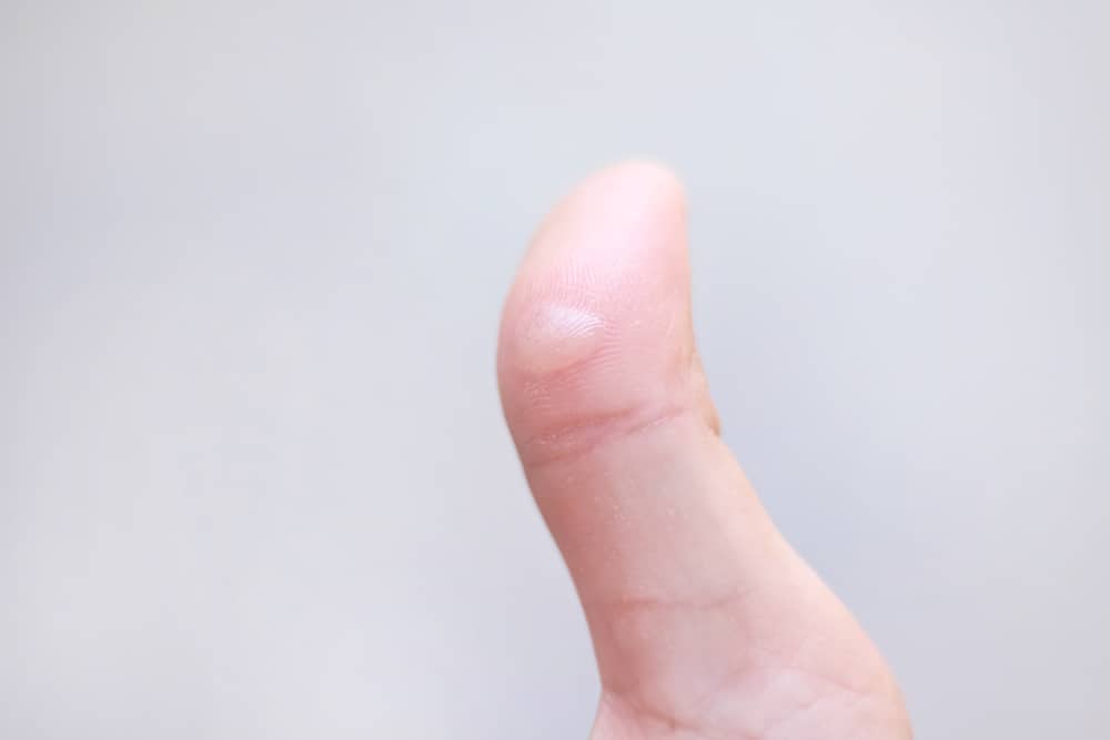 Blisters with fluid inside on thumb finger