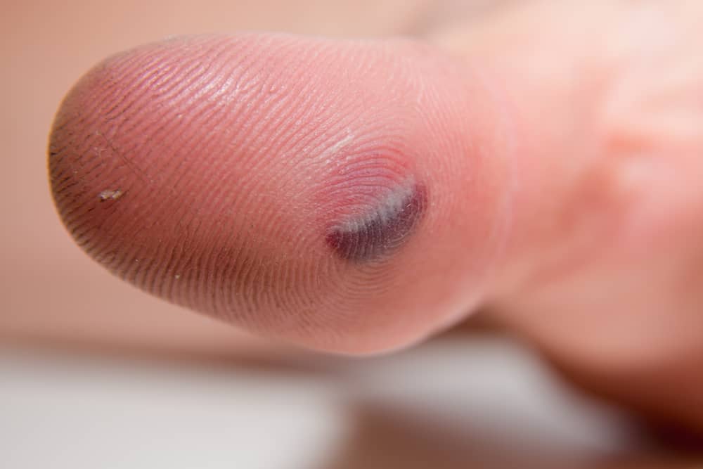 Blood blister under the thumb skin